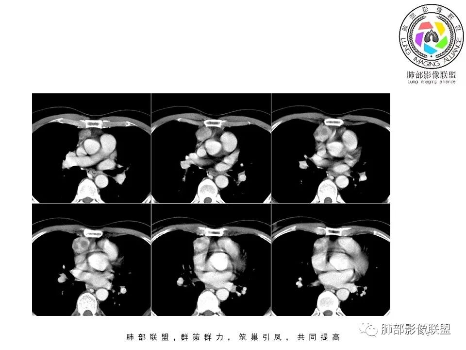 影像PPT - 【病例】前纵隔区最常见的肿瘤—胸腺瘤1例CT-6 影像PPT - 【病例】前纵隔区最常见的肿瘤—胸腺瘤1例CT-6