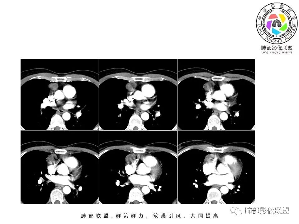 影像PPT - 【病例】前纵隔区最常见的肿瘤—胸腺瘤1例CT-5 影像PPT - 【病例】前纵隔区最常见的肿瘤—胸腺瘤1例CT-5