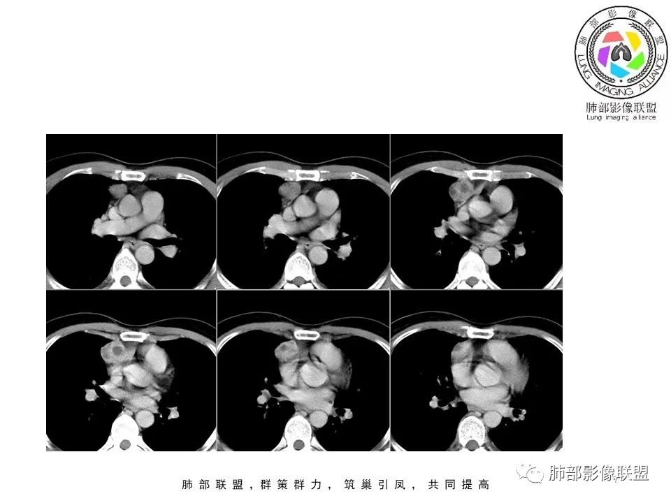 影像PPT - 【病例】前纵隔区最常见的肿瘤—胸腺瘤1例CT-7 影像PPT - 【病例】前纵隔区最常见的肿瘤—胸腺瘤1例CT-7