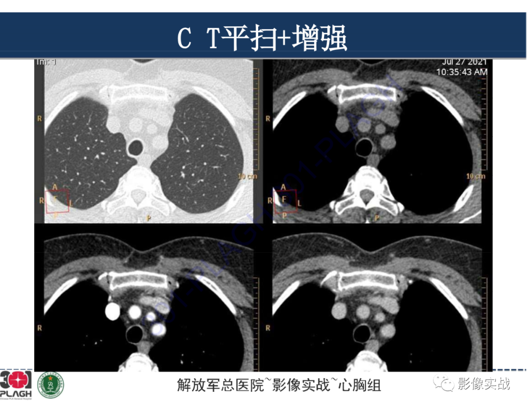 影像PPT - 【病例】前纵隔侵袭性胸腺瘤1例CT影像-3