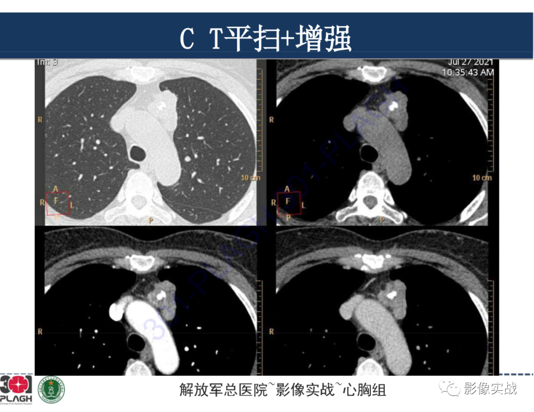 影像PPT - 【病例】前纵隔侵袭性胸腺瘤1例CT影像-5