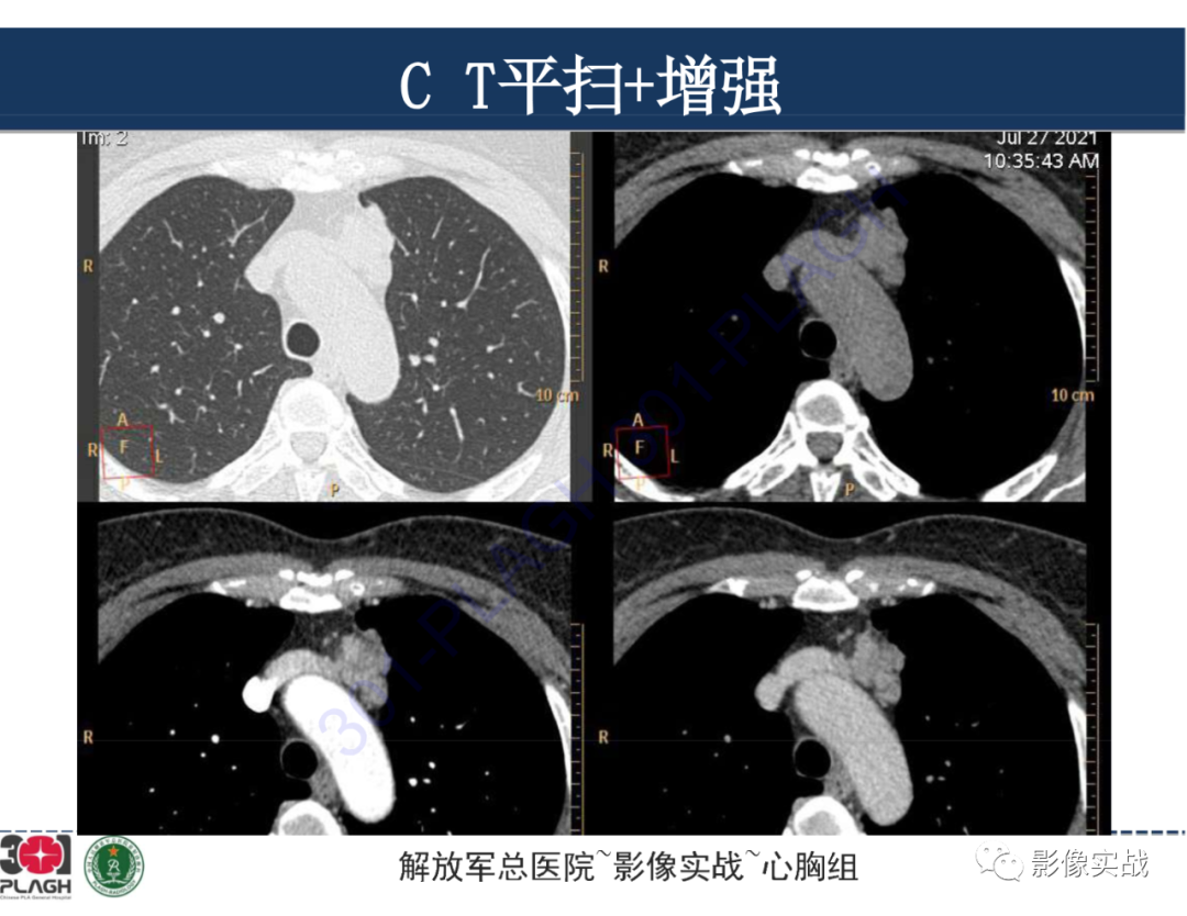 影像PPT - 【病例】前纵隔侵袭性胸腺瘤1例CT影像-4