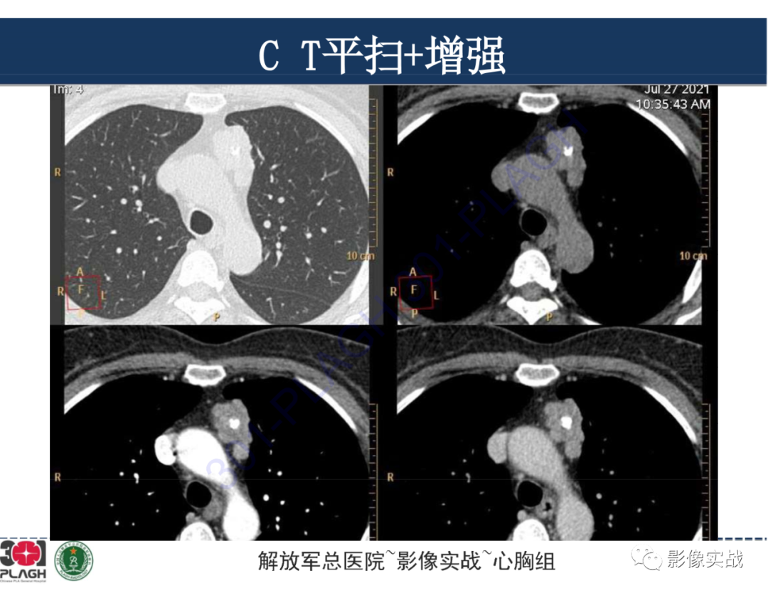 影像PPT - 【病例】前纵隔侵袭性胸腺瘤1例CT影像-6