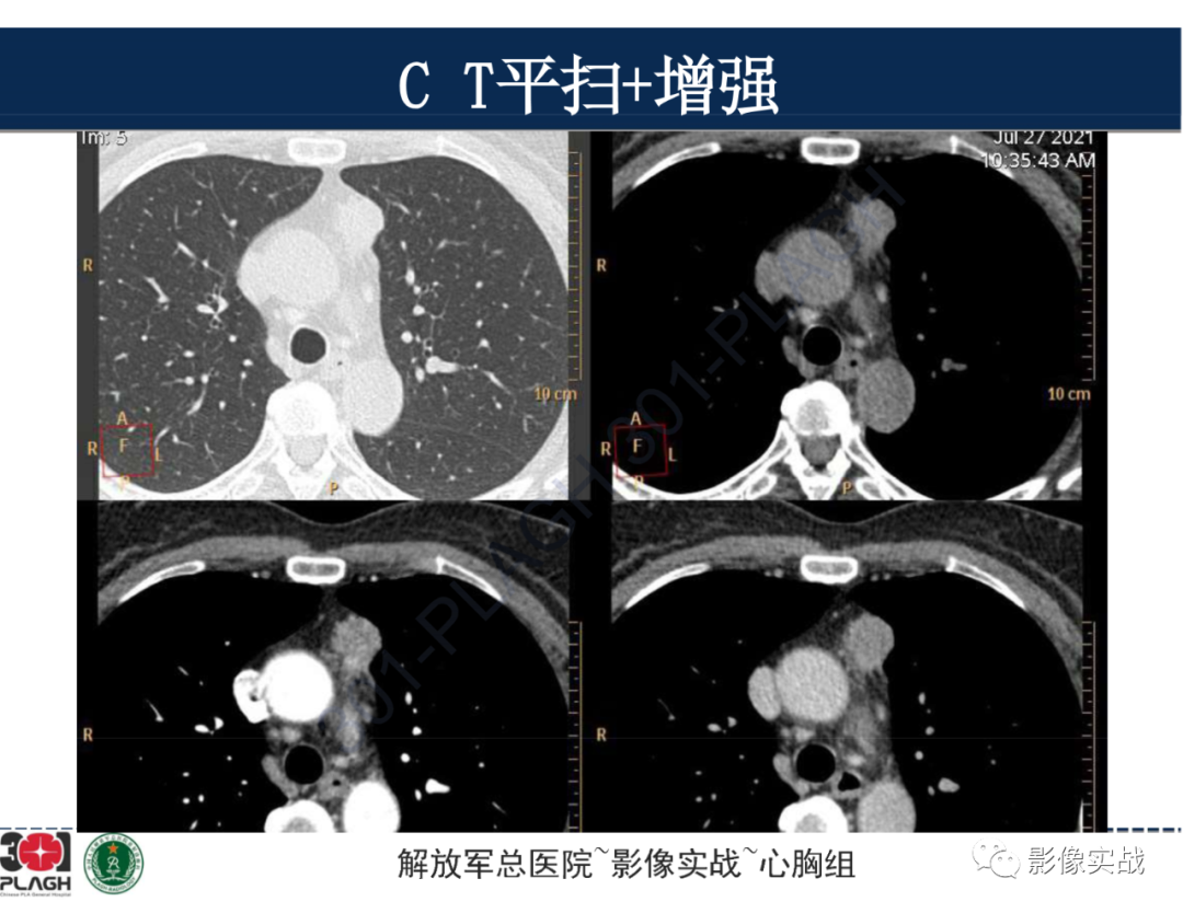 影像PPT - 【病例】前纵隔侵袭性胸腺瘤1例CT影像-7