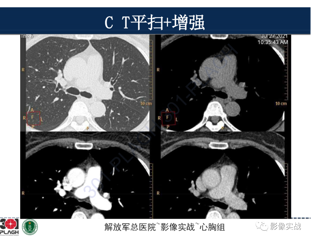 影像PPT - 【病例】前纵隔侵袭性胸腺瘤1例CT影像-8