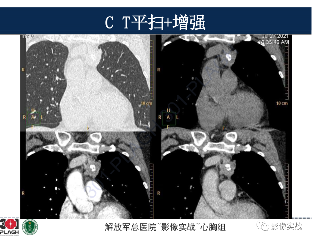 影像PPT - 【病例】前纵隔侵袭性胸腺瘤1例CT影像-11
