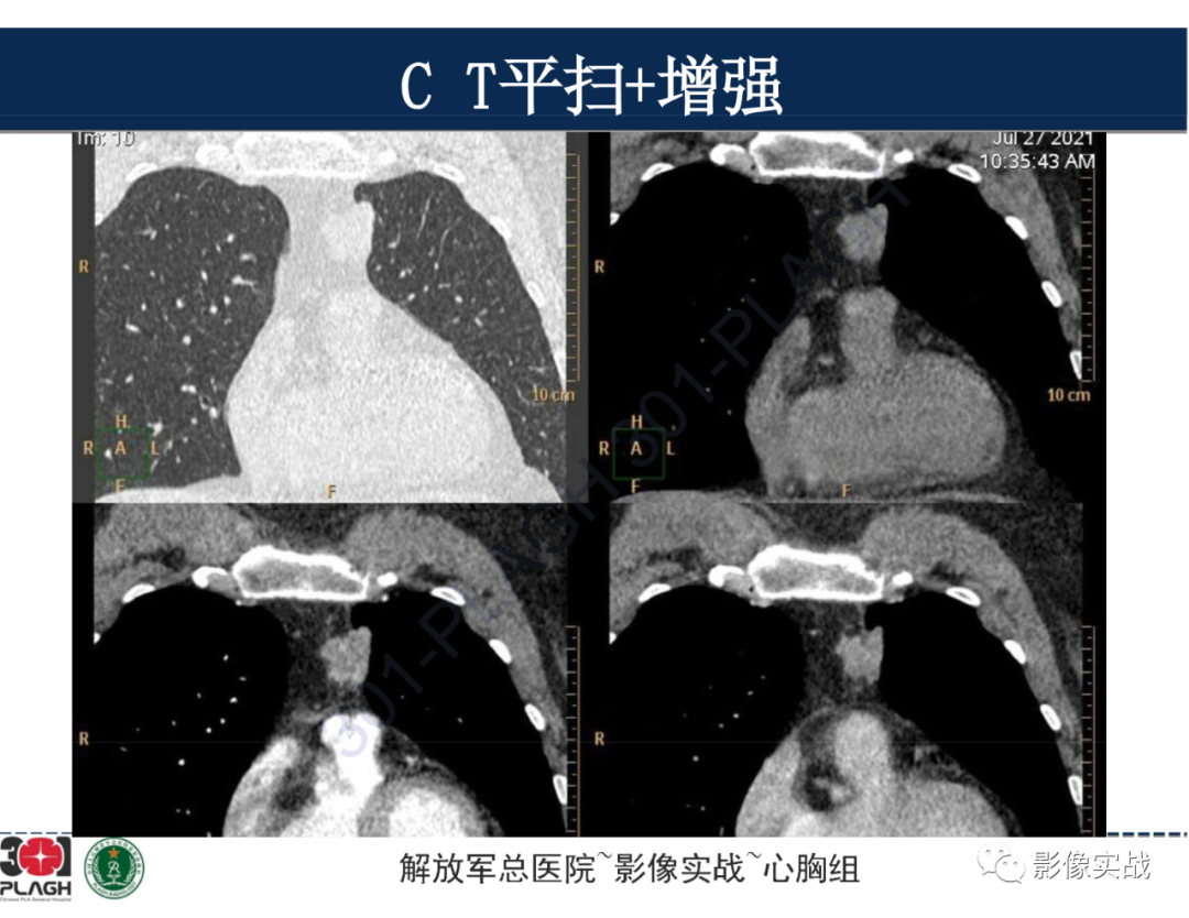 影像PPT - 【病例】前纵隔侵袭性胸腺瘤1例CT影像-9