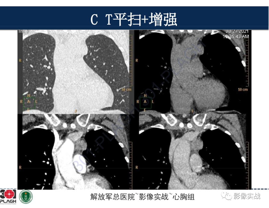 影像PPT - 【病例】前纵隔侵袭性胸腺瘤1例CT影像-10