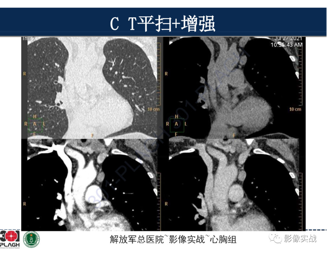 影像PPT - 【病例】前纵隔侵袭性胸腺瘤1例CT影像-12