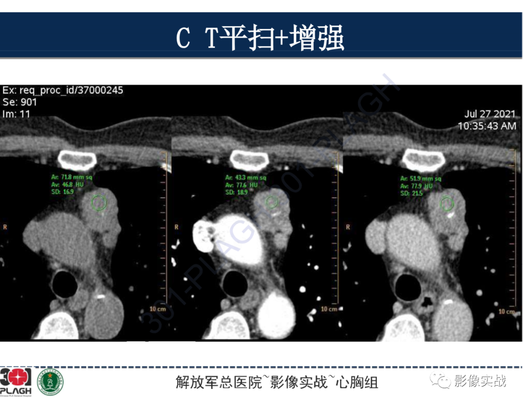 影像PPT - 【病例】前纵隔侵袭性胸腺瘤1例CT影像-13
