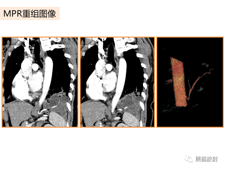 影像PPT - 【病例】肺隔离症2例CT影像-8