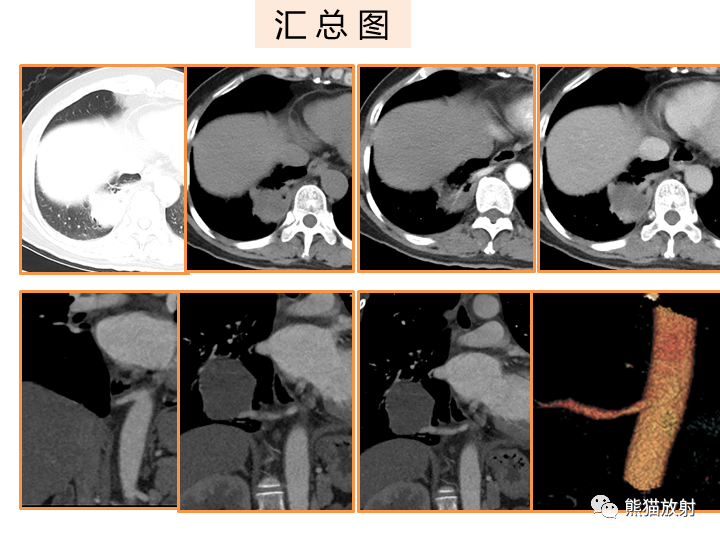 影像PPT - 【病例】肺隔离症2例CT影像-18