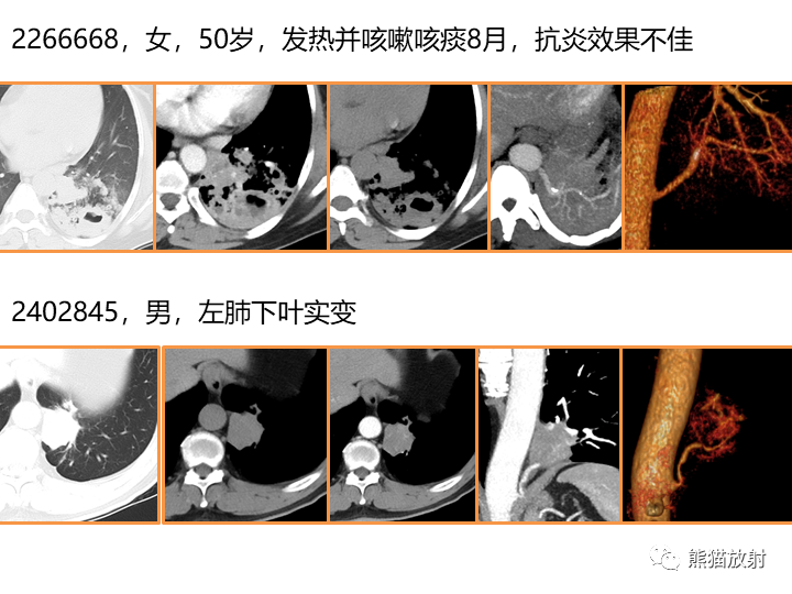 影像PPT - 【病例】肺隔离症2例CT影像-27