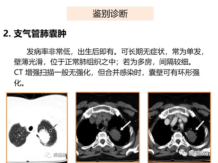 影像PPT - 【病例】肺隔离症2例CT影像-29