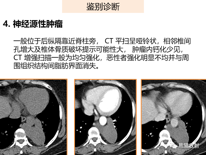 影像PPT - 【病例】肺隔离症2例CT影像-31