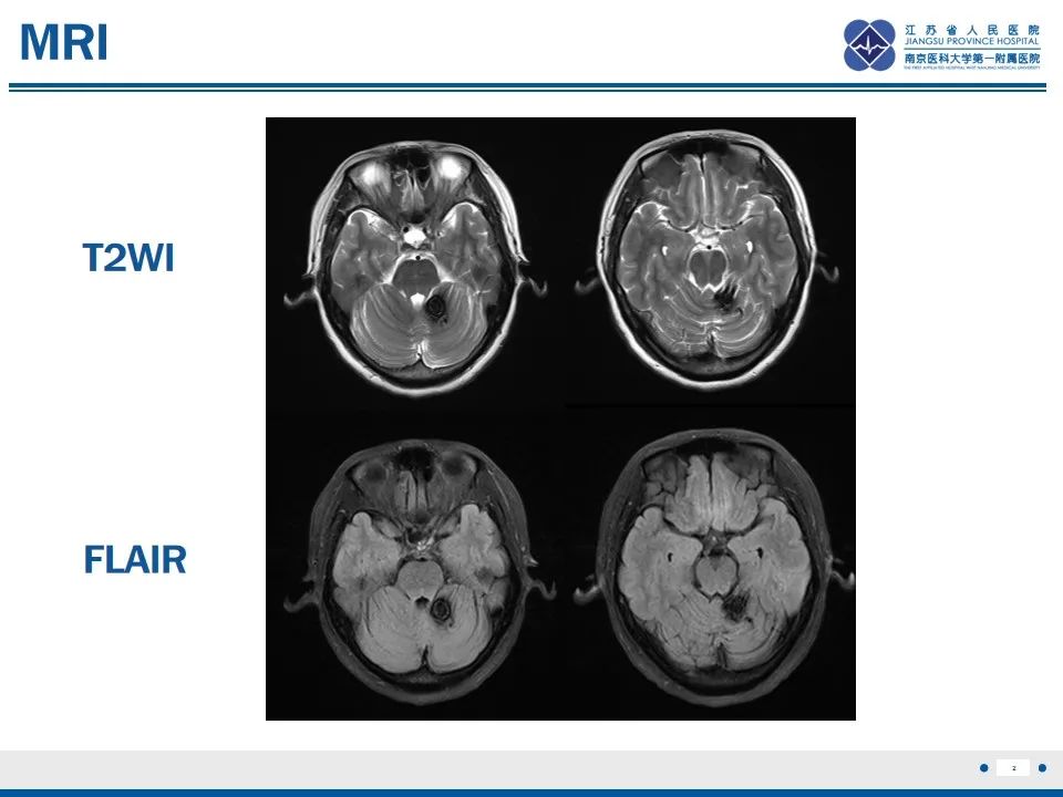 影像PPT - 【PPT】海绵状血管瘤伴发育性静脉畸形-3
