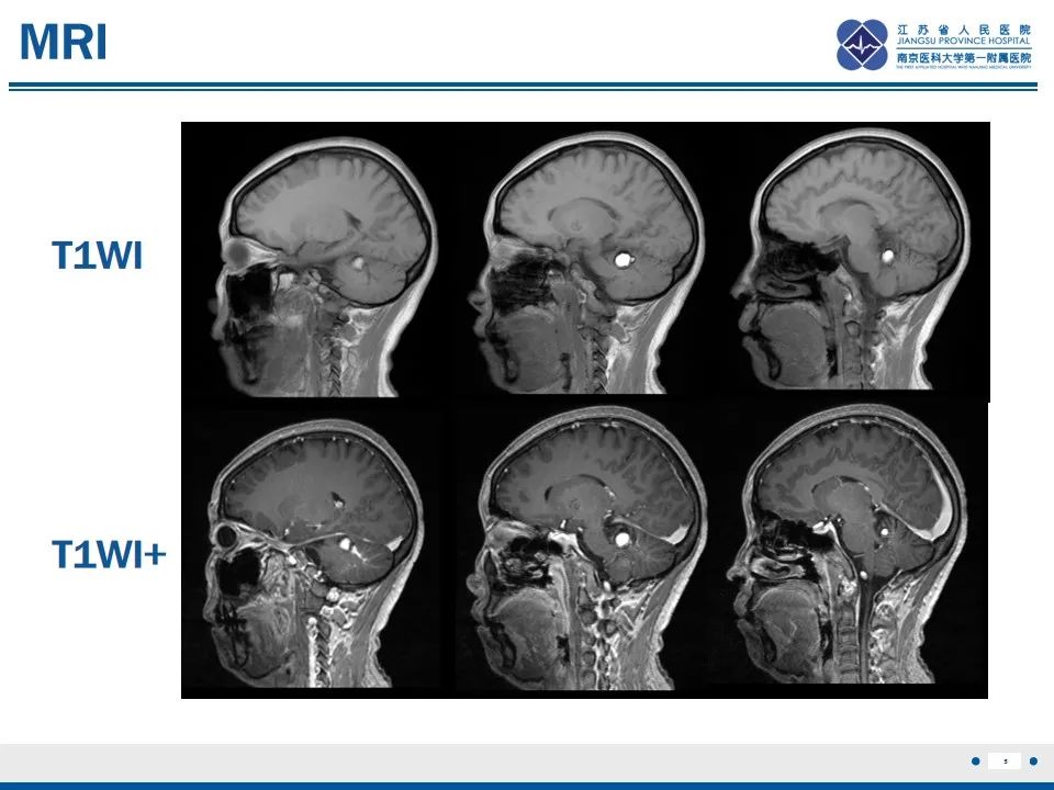 影像PPT - 【PPT】海绵状血管瘤伴发育性静脉畸形-6