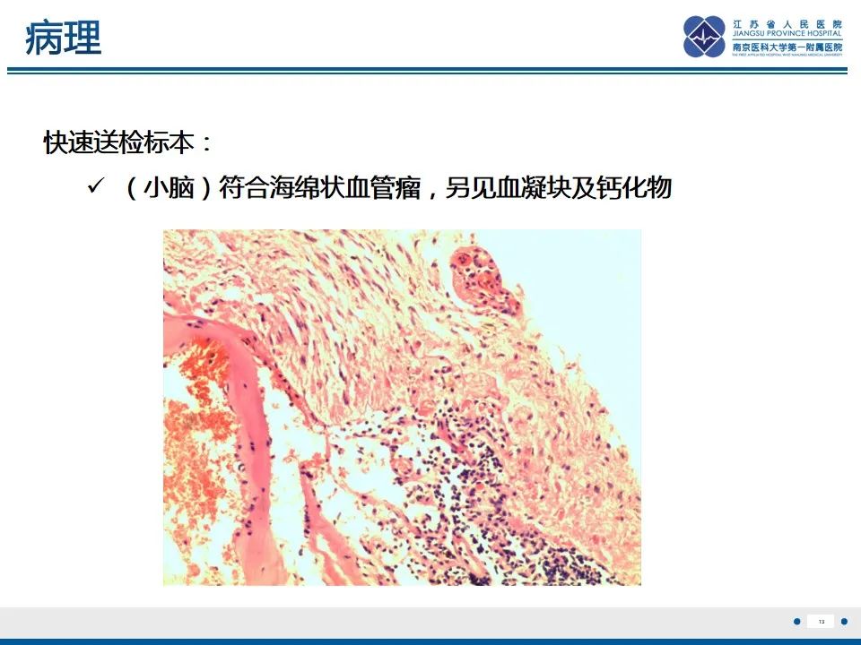 影像PPT - 【PPT】海绵状血管瘤伴发育性静脉畸形-14
