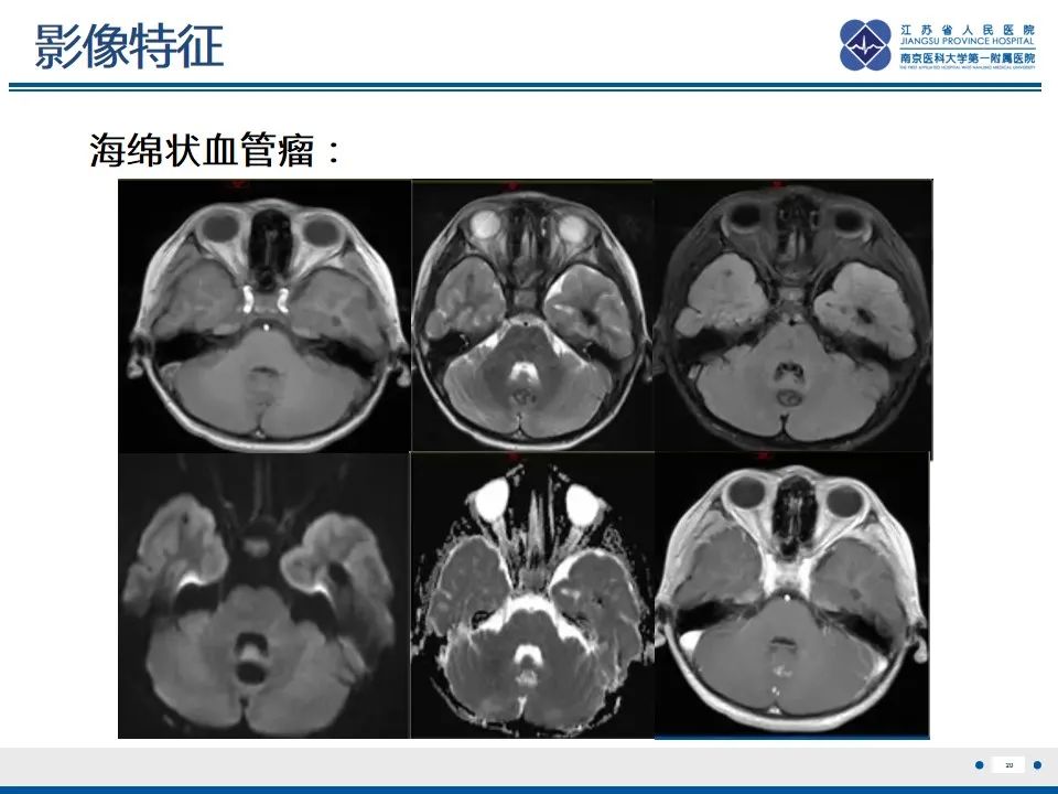 影像PPT - 【PPT】海绵状血管瘤伴发育性静脉畸形-21