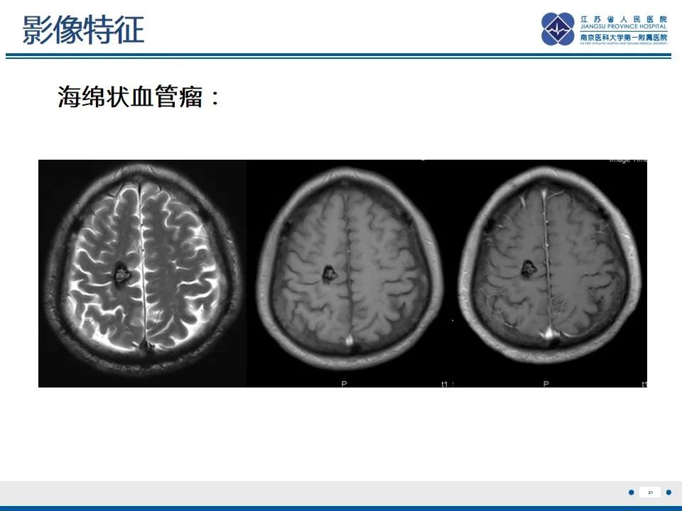 影像PPT - 【PPT】海绵状血管瘤伴发育性静脉畸形-22