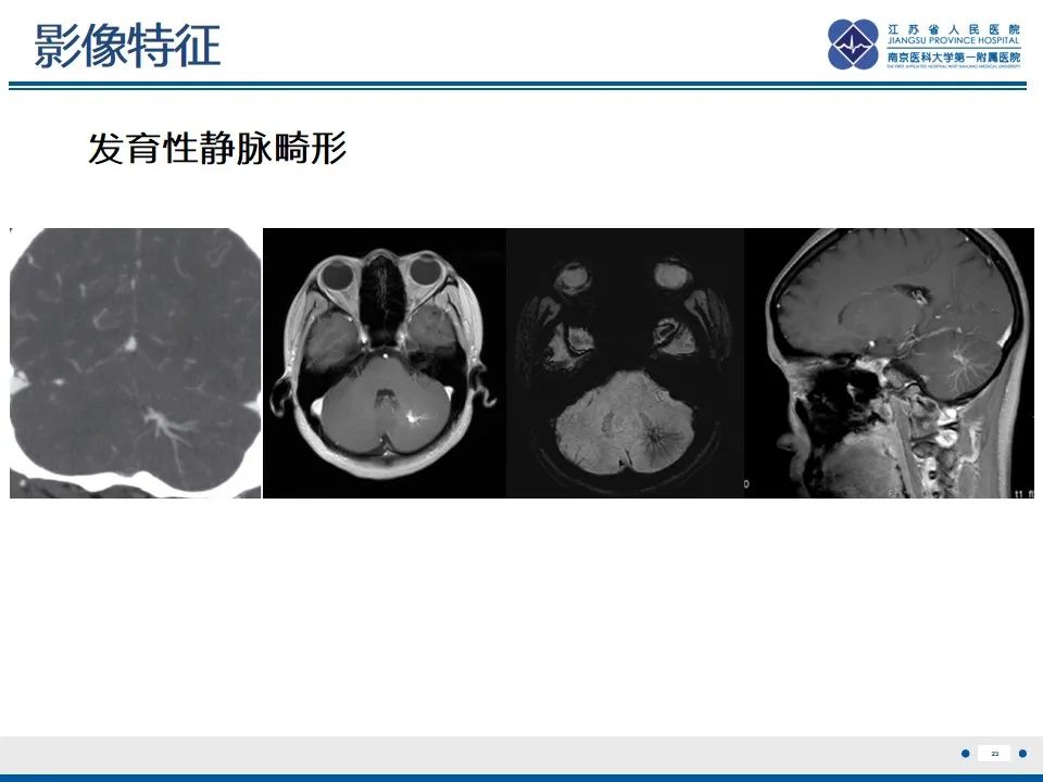 影像PPT - 【PPT】海绵状血管瘤伴发育性静脉畸形-24