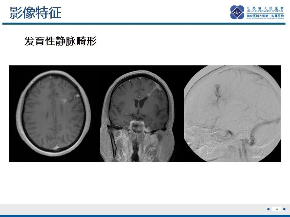 影像PPT - 【PPT】海绵状血管瘤伴发育性静脉畸形-25
