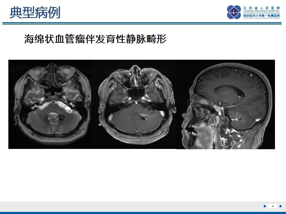 影像PPT - 【PPT】海绵状血管瘤伴发育性静脉畸形-26