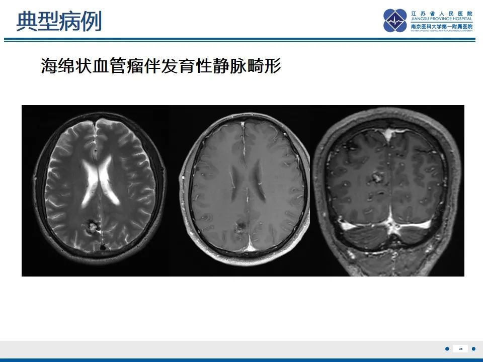 影像PPT - 【PPT】海绵状血管瘤伴发育性静脉畸形-27