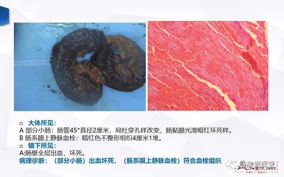 影像PPT - 【PPT】急性肠系膜血管栓塞的影像诊断-5