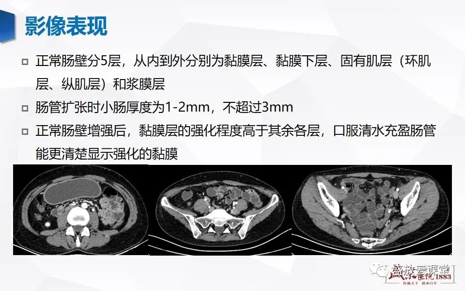 影像PPT - 【PPT】急性肠系膜血管栓塞的影像诊断-14