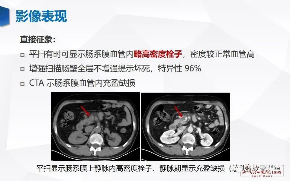 影像PPT - 【PPT】急性肠系膜血管栓塞的影像诊断-15