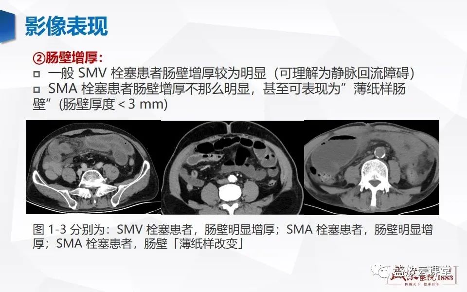 影像PPT - 【PPT】急性肠系膜血管栓塞的影像诊断-17