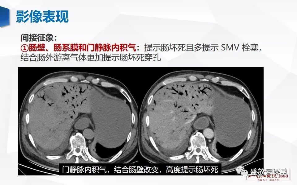 影像PPT - 【PPT】急性肠系膜血管栓塞的影像诊断-16