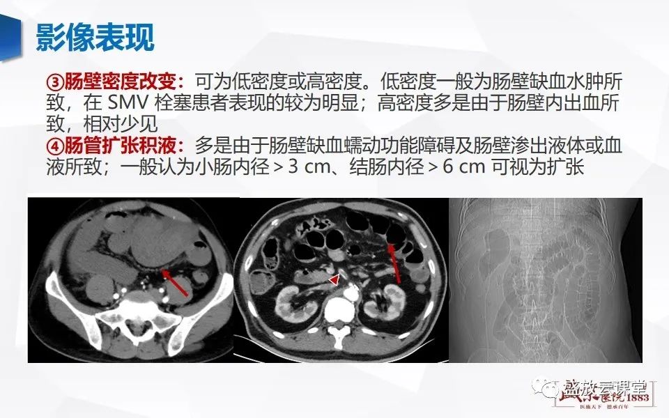 影像PPT - 【PPT】急性肠系膜血管栓塞的影像诊断-18