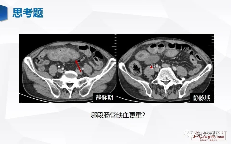影像PPT - 【PPT】急性肠系膜血管栓塞的影像诊断-22