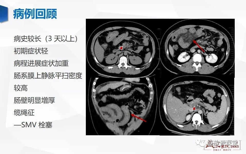 影像PPT - 【PPT】急性肠系膜血管栓塞的影像诊断-21
