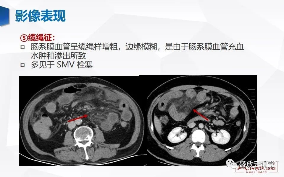 影像PPT - 【PPT】急性肠系膜血管栓塞的影像诊断-19