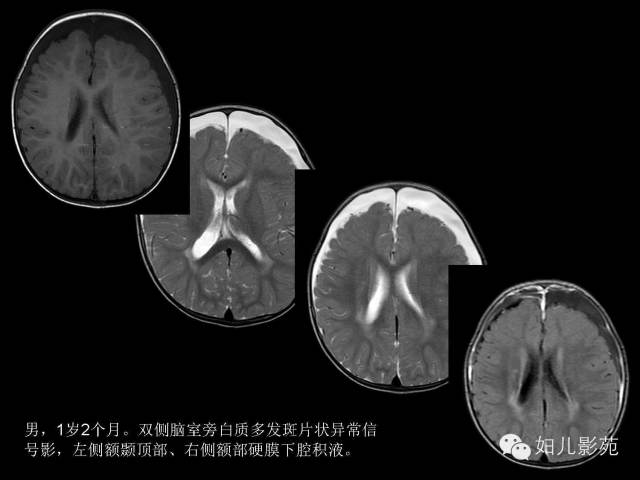 影像PPT - 【PPT】手足口病的神经系统影像表现-9