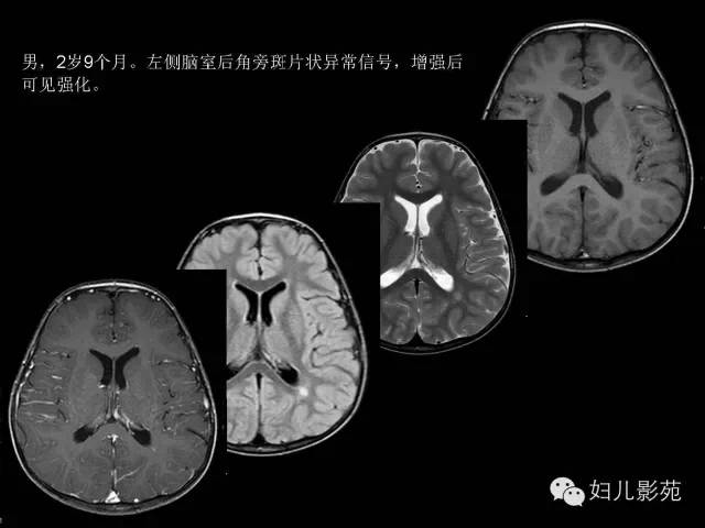影像PPT - 【PPT】手足口病的神经系统影像表现-8
