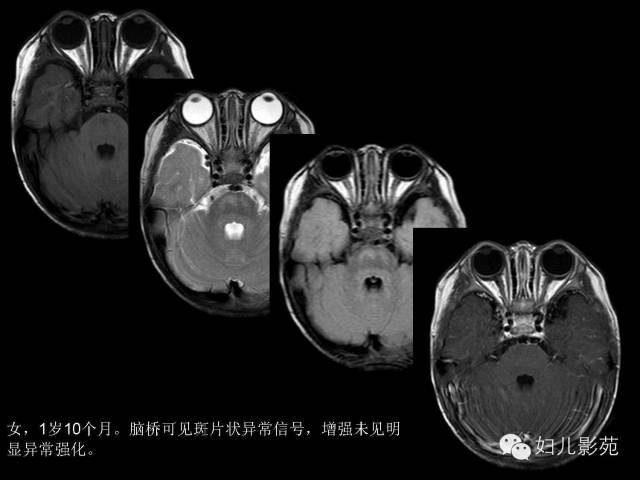 影像PPT - 【PPT】手足口病的神经系统影像表现-10