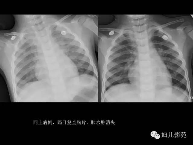 影像PPT - 【PPT】手足口病的神经系统影像表现-12