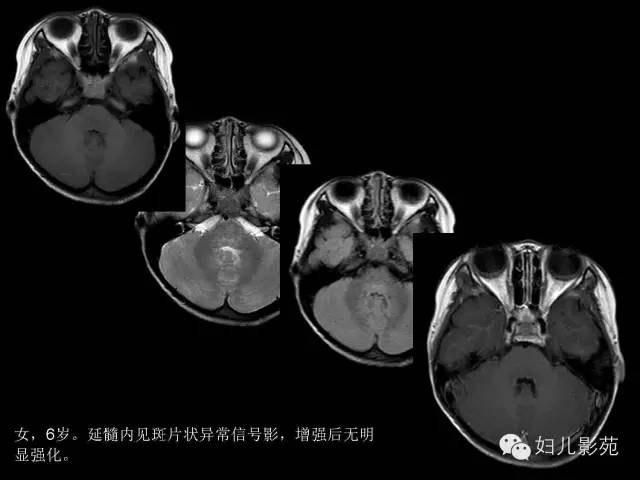 影像PPT - 【PPT】手足口病的神经系统影像表现-13
