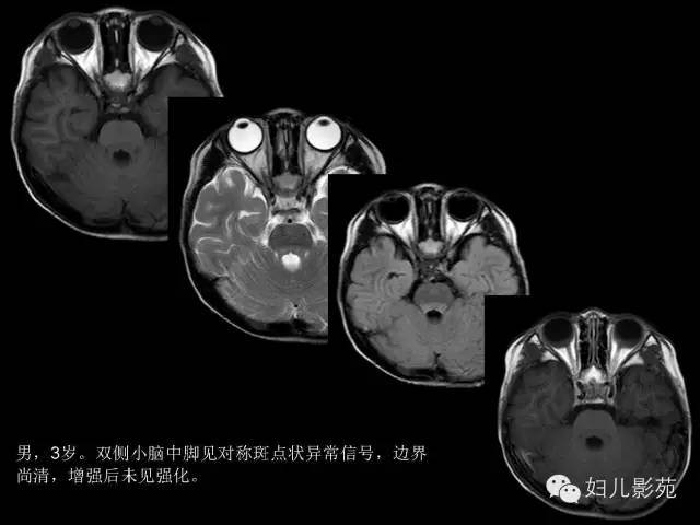 影像PPT - 【PPT】手足口病的神经系统影像表现-14