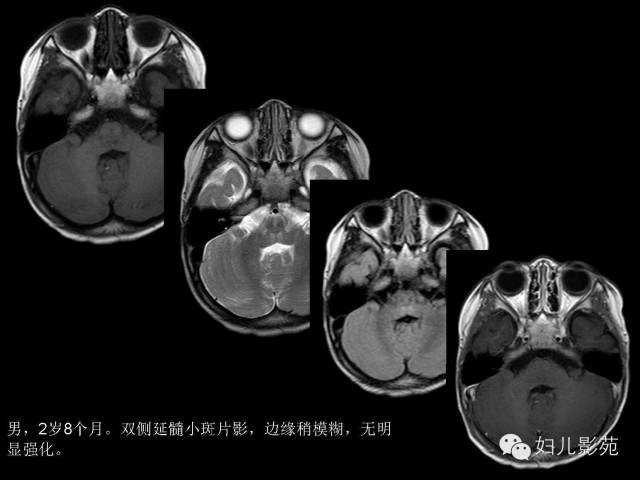 影像PPT - 【PPT】手足口病的神经系统影像表现-11
