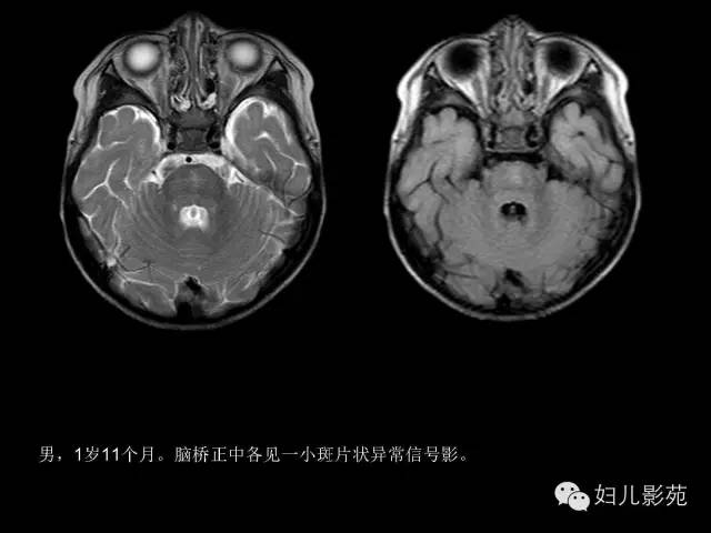 影像PPT - 【PPT】手足口病的神经系统影像表现-15