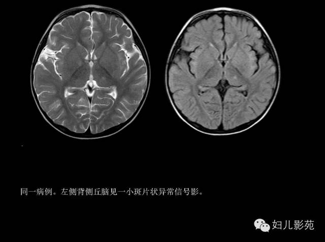 影像PPT - 【PPT】手足口病的神经系统影像表现-16