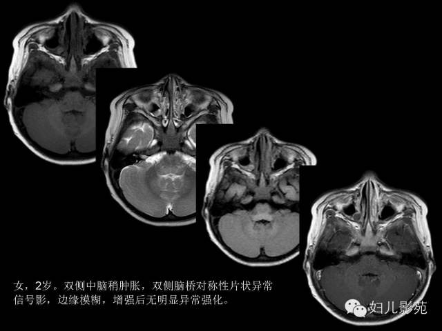 影像PPT - 【PPT】手足口病的神经系统影像表现-17