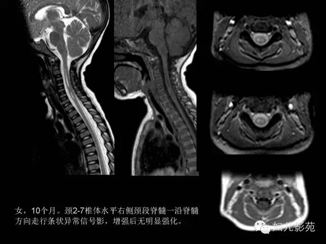 影像PPT - 【PPT】手足口病的神经系统影像表现-19