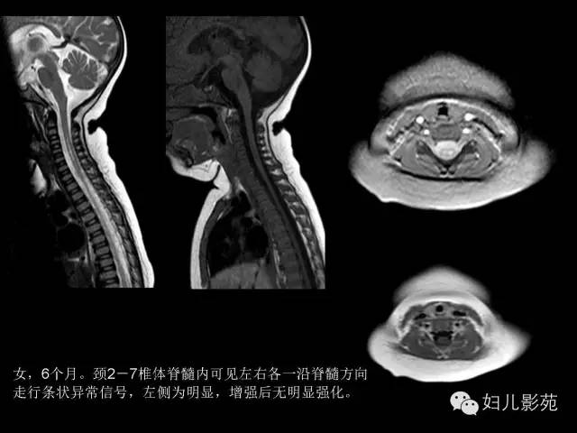 影像PPT - 【PPT】手足口病的神经系统影像表现-21