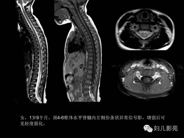 影像PPT - 【PPT】手足口病的神经系统影像表现-20